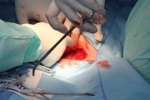 Cirugía para tratar el cáncer 1 Cirugía para tratar el cáncer