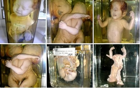 Piezas anatómicas de la morgue judicial 7 1 malformaciones congenitas