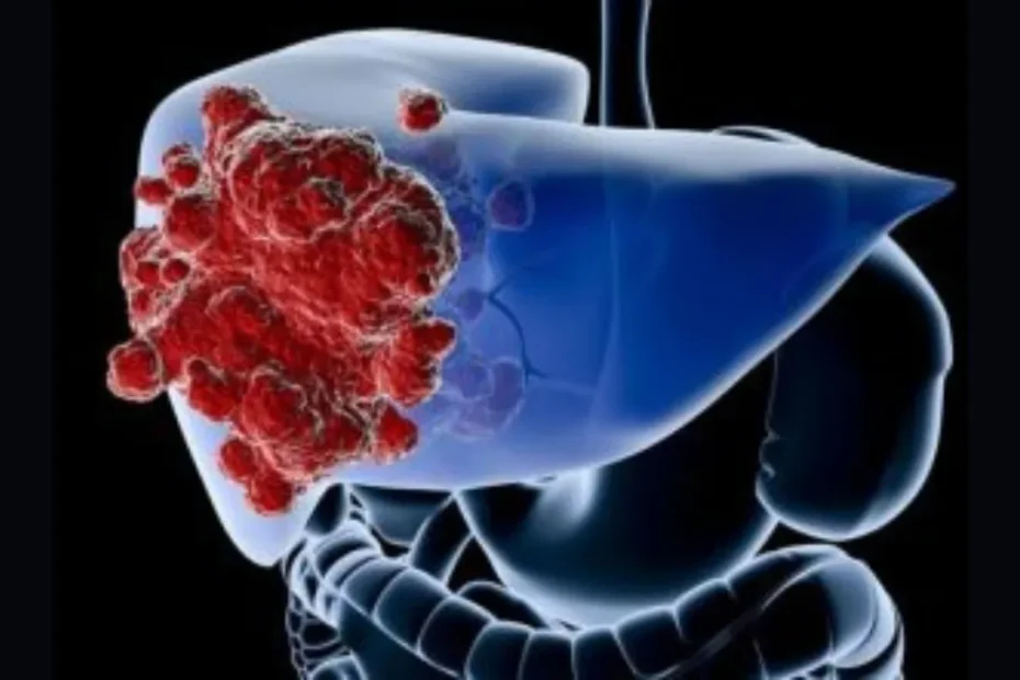 Cáncer primario de Hígado