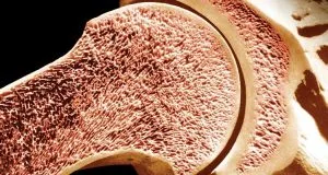 El cáncer según la ubicación en el cuerpo Parte 1 1 Cáncer de hueso - El cáncer según la ubicación en el cuerpo Parte 1