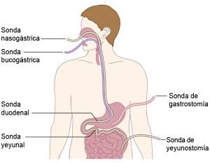 ¿Qué es la Nutrición Enteral? 4 Yeyunostomía