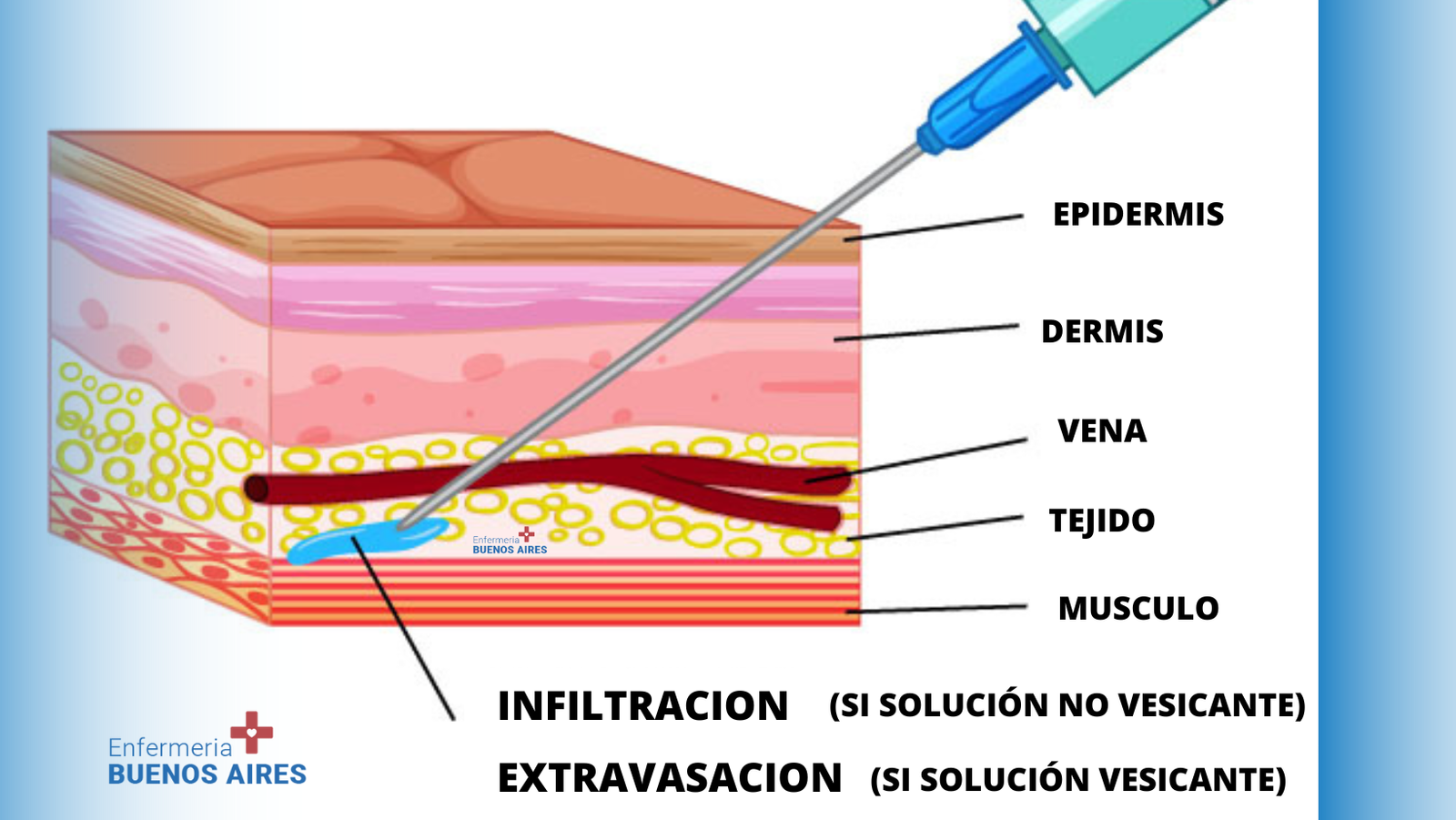 Extravasación - Agentes citostáticos