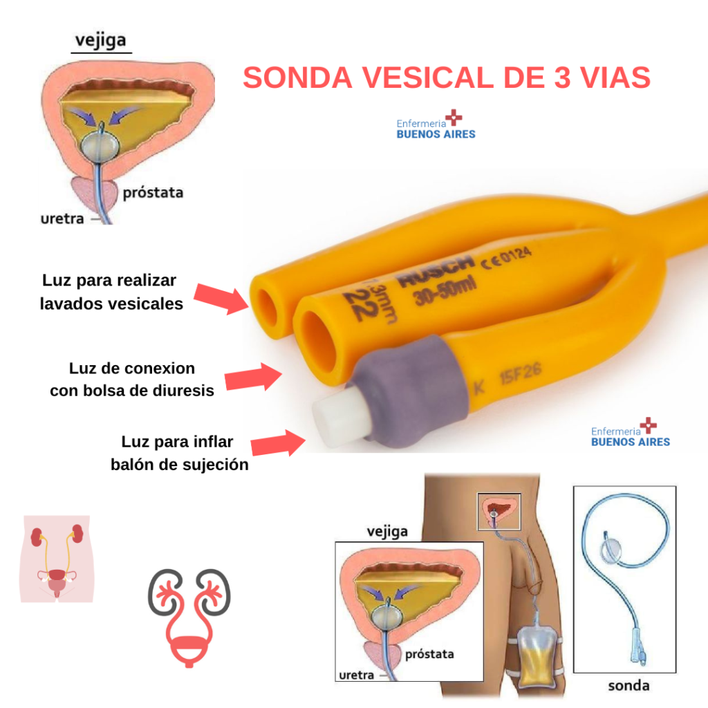 Sonda vesical 3 vias 2 Sonda vesical 3 vias