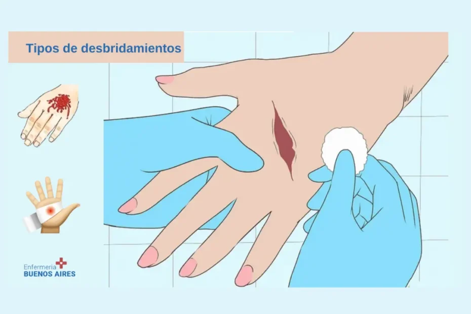 Tipos de desbridamientos