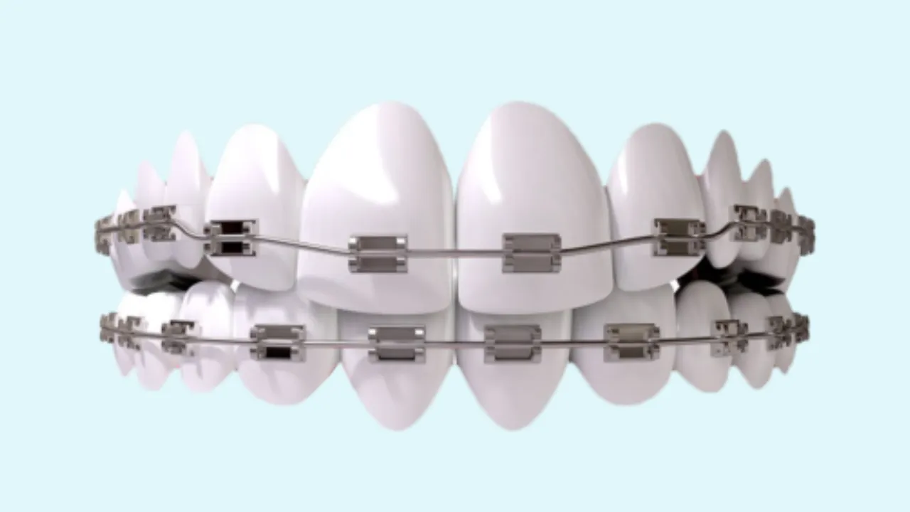 Invisalign Argentina 3 Invisalign Argentina