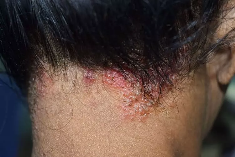 Tratamiento para el Hongo en la Cabeza 6 Hongos en la cabeza